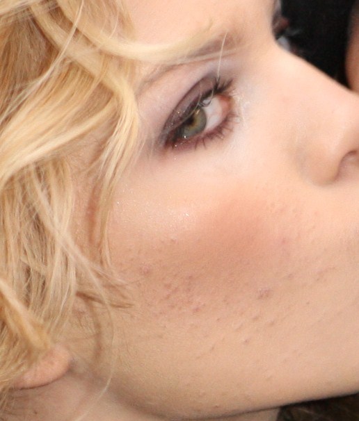 AnnaLynne McCord acne pictures