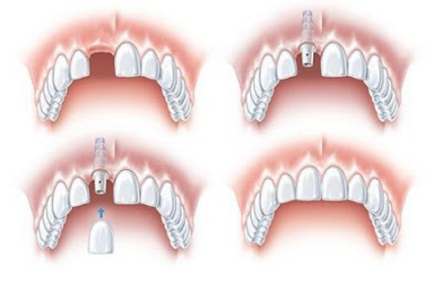 Implant cấy ghép cho những trường hợp nào?