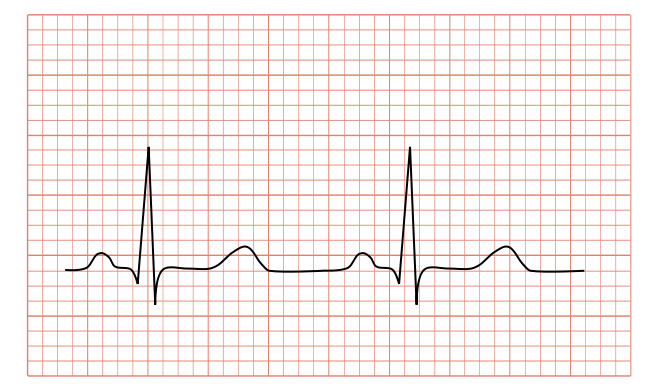 十二導程心電圖 12 Lead Electrocardiography