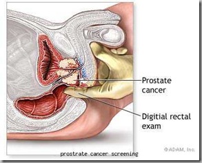 prostrate cancer screening