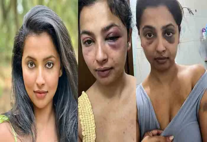 News,National,India,Actress,Bangalore,Entertainment,Allegation,Complaint,Police,Social-Media,Lifestyle & Fashion,Assault,Threat,attack,Top-Headlines,Latest-News, Actress Anicka Vikraman Narrates Attack Of Ex-Boyfriend