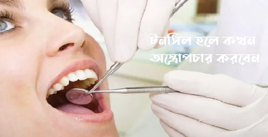 টনসিল হলে কখন অস্ত্রোপচার করবেন