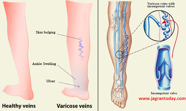 वेरीकोज वेंस क्या है और इससे बचाव के उपाय
