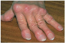 Rematoid Artritis 