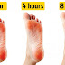 How to get rid of blisters on feet naturally