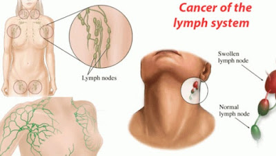 What are the Early Signs Of Lymphoma.