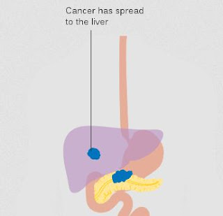 Pancreatic cancer metastasized – stage M1