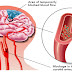 SETELAH BACA !!! MOHON UNTUK DI BAGIKAN INFO PENTING INI  !!      8 TIPS MENCEGAH STROKE SEBELUM USIA KITA MENCAPAI UMUR 40 TAHUN