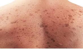  त्वचा कैंसर ( Skin Cancer )