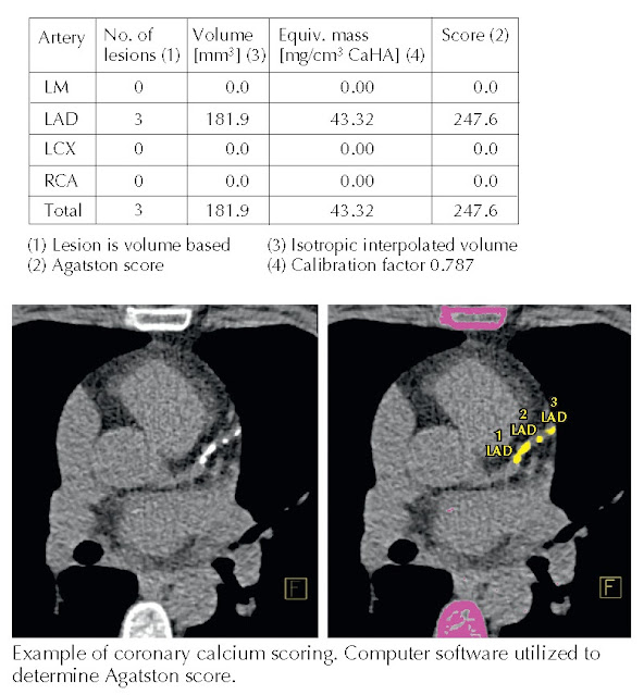 Coronary calcium scoring