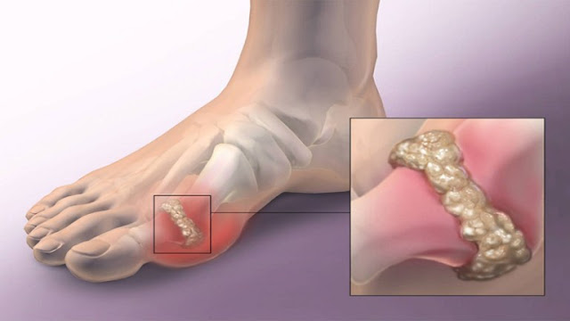 The Easiest and Quickest Way To Eliminate Uric Acid Crystallization From Your Body To Stop Gout And Joint Pain