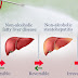 Treatment of Non-Alcoholic Fatty Liver Disease (NAFLD)