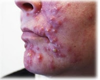 5 Ways to cure acne stones naturally