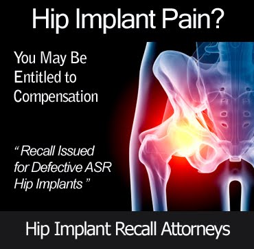 Depuy Hip Replacement Recall. a DePuy hip replacement,