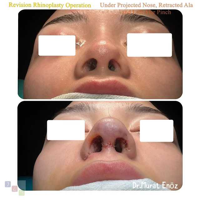 revision rhinoplasty, underprojected nose, retracted ala, alar pinch deformity, secondary nose surgery, nasal tip correction, rhinoplasty complications
