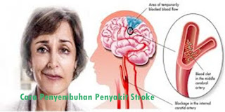 Obat Stroke Ringan