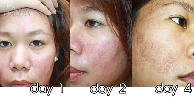 The Beauty Bin Fractional Co2 Laser Timeline