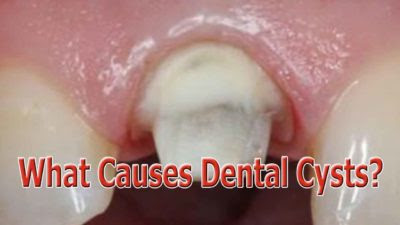 Dental Cysts