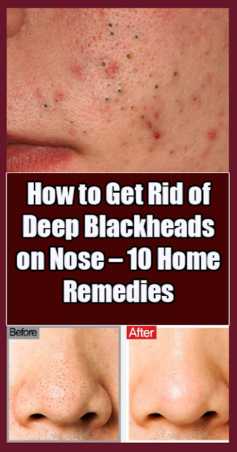 10 Ways To Get Rid Of Deep Blackheads