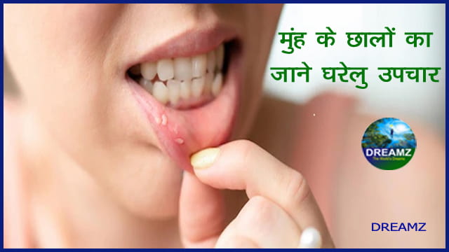 Mouth ulcer treatment in hindi|Home remedies for mouth ulcers in hindi|Mouth Ulcer in Hindi|मुंह के छालों का जाने घरेलू उपचार