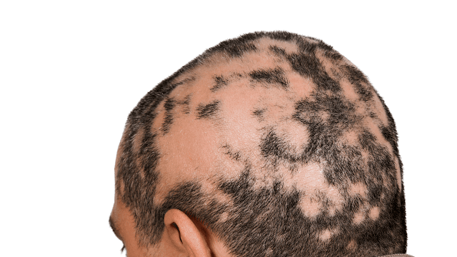 Treatments for bald spots, barbies beauty bits