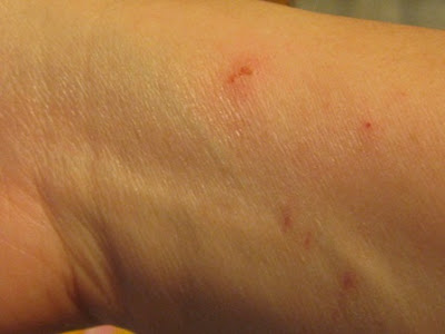 poison sumac rash images. mild poison ivy rashes. bad