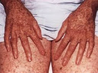 Is Skin Cancer Considered An Autoimmune Disease