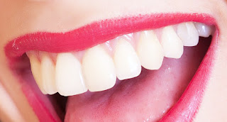 dental veneers