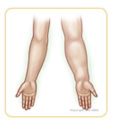 Resultado de imagen para linfedema brazo