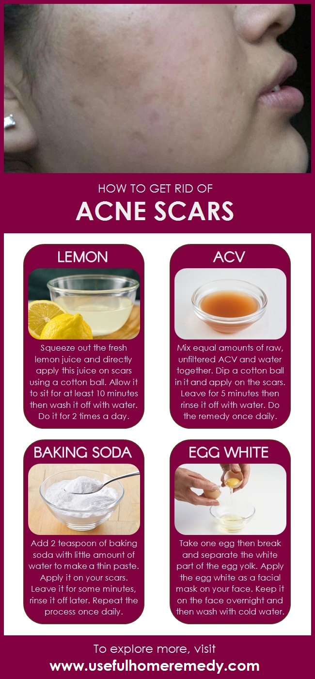 how to get rid of acne scars overnight