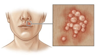 1형 헤르페스 증상 설명 사진