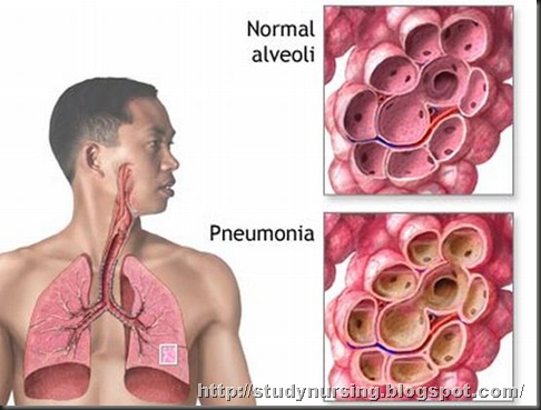 pneumonia-virus-protein-model-discovered_5965