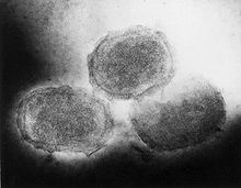 Le molluscum contagiosum est une lésion dermatologique contagieuse induite par un virus. La lésion est caractérisé par une papule arrondie ombiliquée de quelques millimètres de diamètre, généralement non prurigineuse (qui ne cause pas de démangeaisons). Ce sont les enfants qui sont le plus souvent touchés par une insuffisance de défense immunitaire contre le virus de la famille des Poxviridae responsable de la dissémination des lésions. Vue au microscope électronique du virus responsable de Molluscum contagiosum