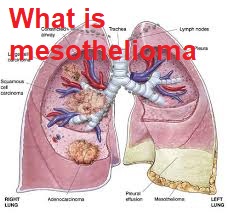 What is Mesothelioma? 