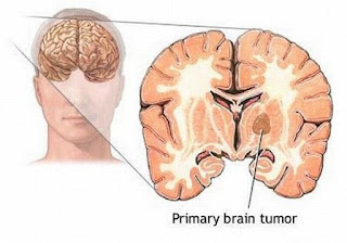 Penyebab dan Gejala Penyakit Kanker Otak Pada Tubuh Manusia, gejala kanker otak, ciri-ciri kanker otak, penyebab kanker otak