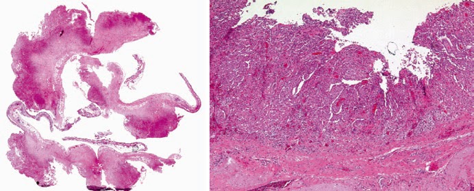 ABOUT MESOTHELIOMA: PATHOHISTOLOGICAL DIAGNOSISAND DIFFERENTIAL DIAGNOSIS