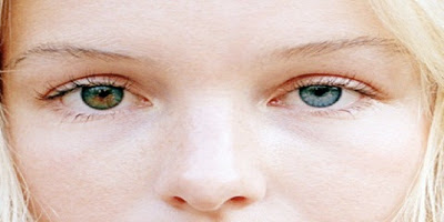 heterochromia, heterochromia iridium, penyakit heterochrommia, anomali, kate bortsworth, beda warna mata, warna mata, pigmen, melanin, operasi heterochromia, klinik heterochromia, rumah sakit mata, operasi heterochromia, warna kulit, warna rambut berbeda, mencegah heterochromia, central heterochromia, rekayasa genetika