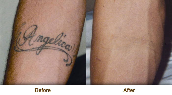 ... tattoo removal, diy-natural tattoo removal, TCA removal, chemical