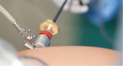 Gynae Laparoscopy Surgery, Laparoscopy Surgery, Laparoscopy Surgeries