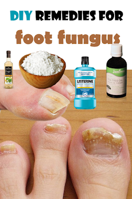 DIY remedies for foot fungus