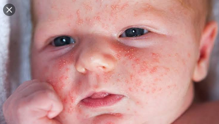 Baby Rash On Face Treatement | Acne Treatment | Heat Rash