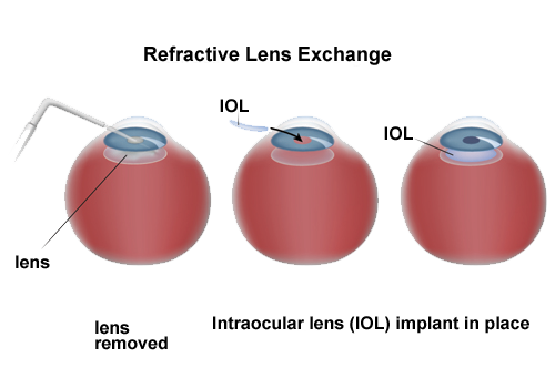 Clear Lens Extraction