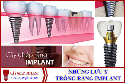 Các kỹ thuật cấy ghép implant