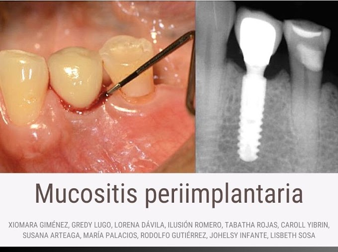 PDF: Mucositis periimplantaria
