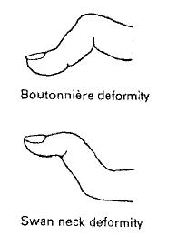 deformities of rheumatoid arthritis