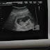 Gambar Ultrasound Anak Dalam Kandungan | Throwback Thursday