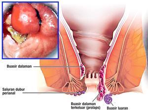 Benjolan Di Anus Setelah Bab