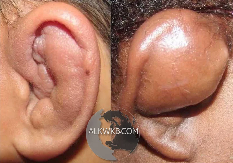 Cauliflower Ear