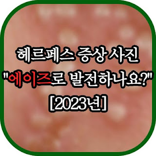 헤르페스 증상 사진 썸네일