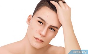 3 Top Acne Skin Care Tips For A Healthier Skin